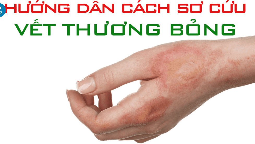 HƯỚNG DẪN SƠ CỨU NGƯỜI BỊ BỎNG DO CHÁY 5 HƯỚNG DẪN SƠ CỨU NGƯỜI BỊ BỎNG DO CHÁY